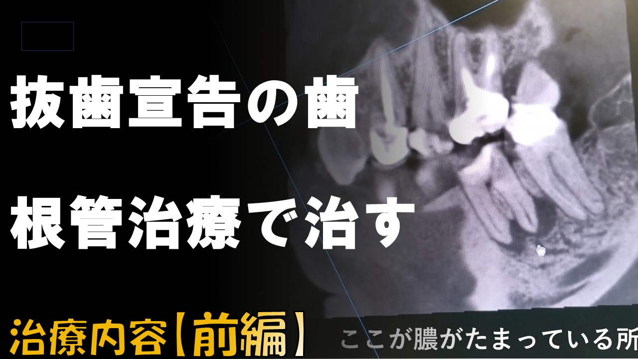 抜歯宣告　根管治療　歯を抜かない　自由が丘　歯医者