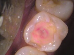 レジン　虫歯　セラミック治療　歯医者　自由が丘