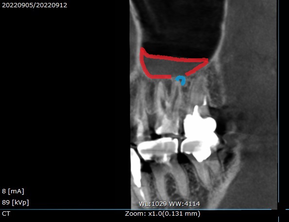 根管治療　マイクロエンド　自由が丘　歯医者　