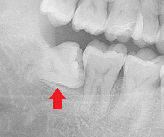 親知らず虫歯　セラミック治療　自由が丘　歯医者