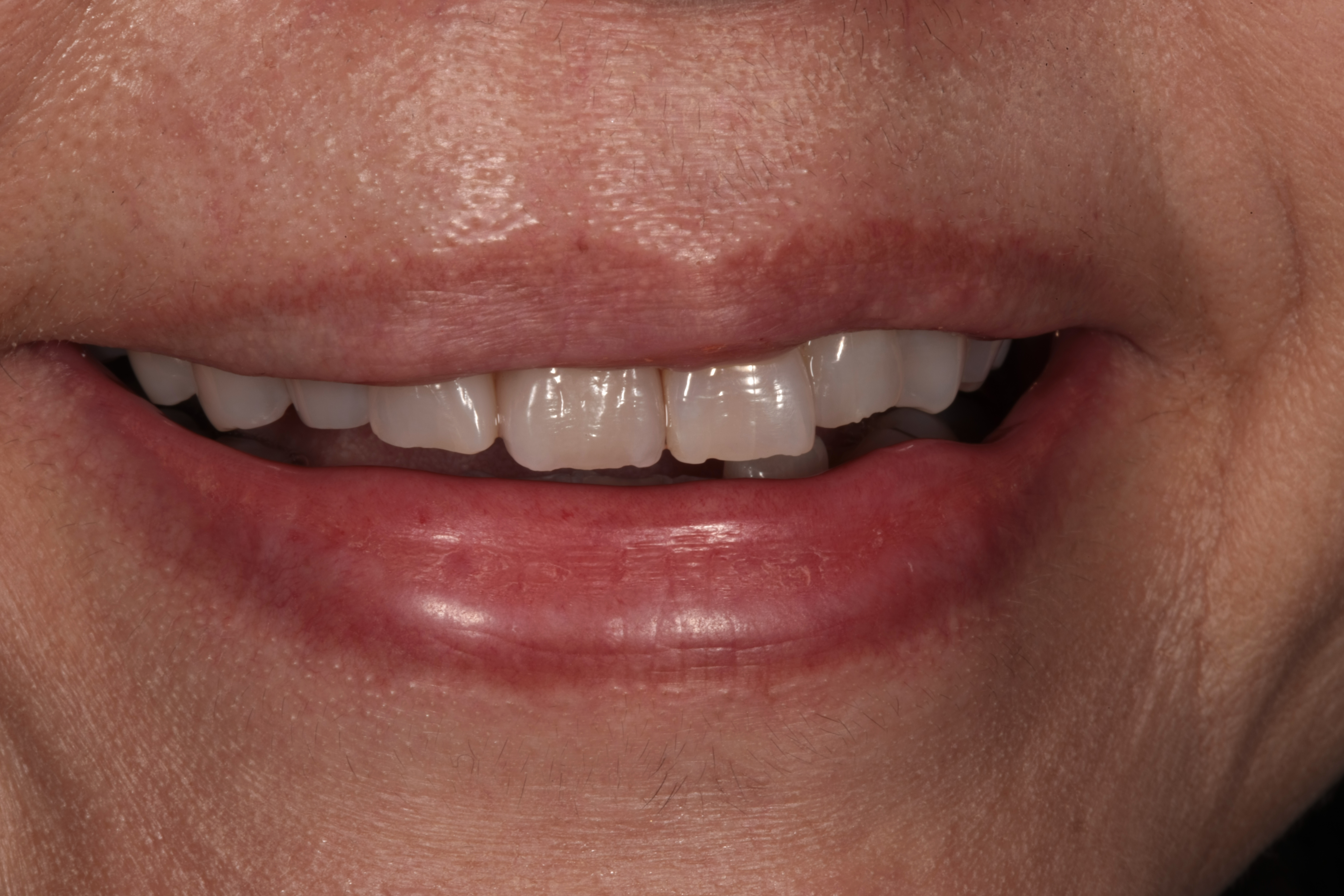 審美歯科 セラミック治療 前歯 自由が丘 歯医者