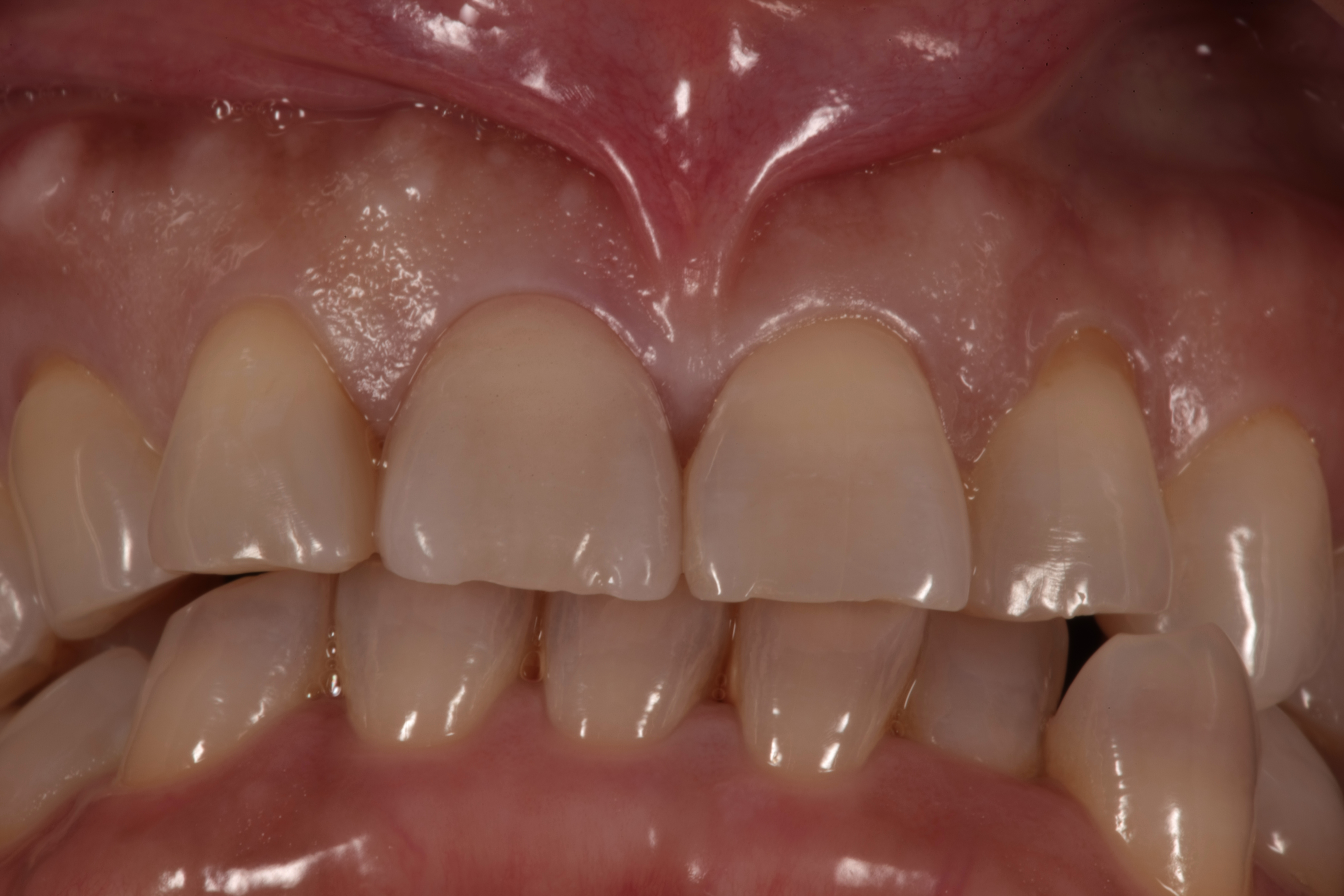 審美歯科 セラミック治療 前歯 自由が丘 歯医者