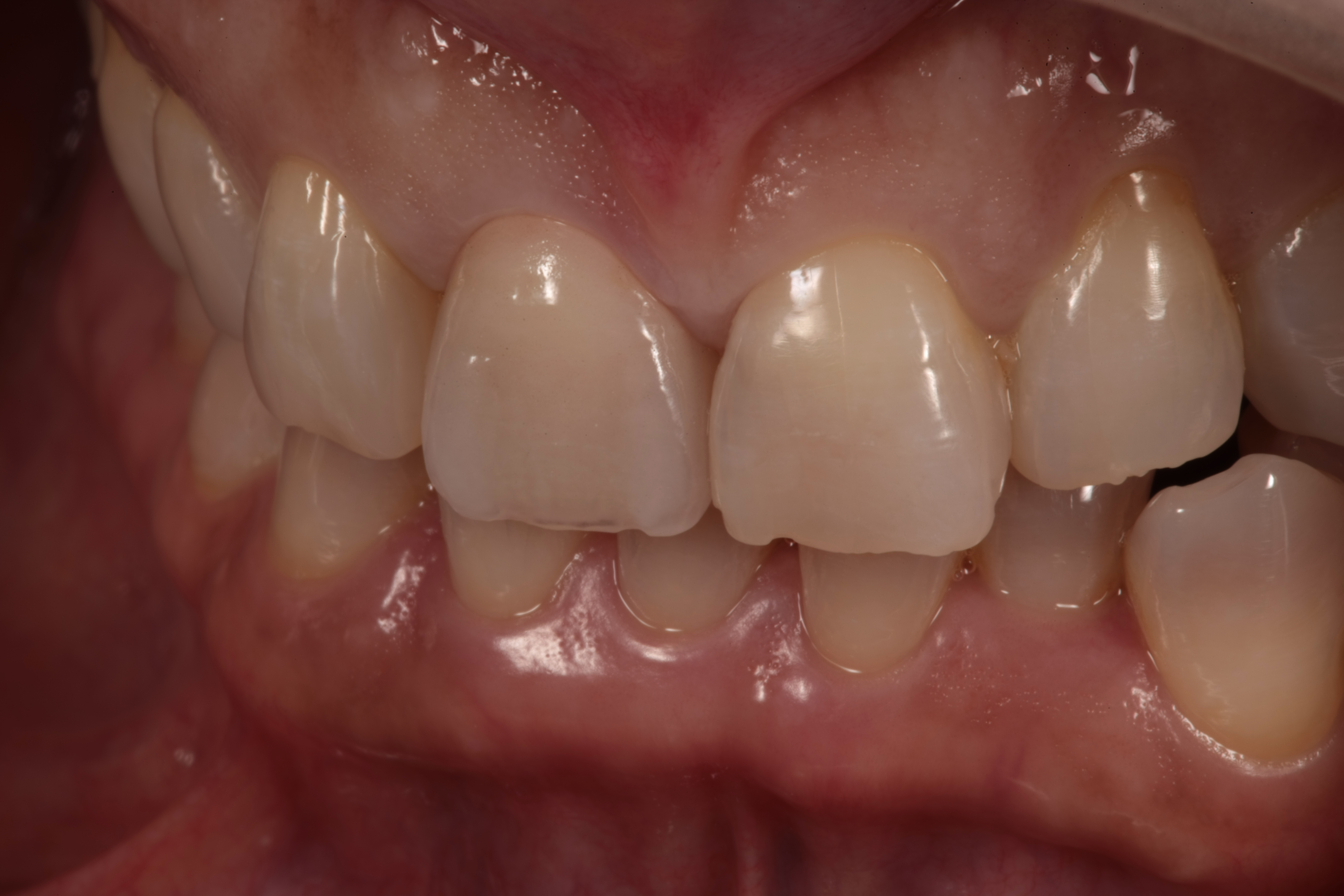 審美歯科 セラミック治療 前歯 自由が丘 歯医者