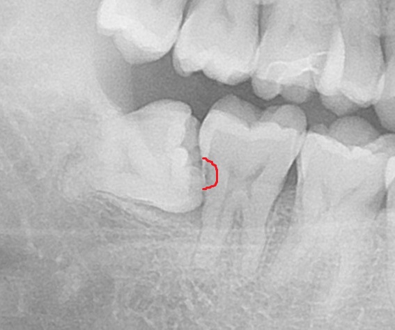 親知らず虫歯　セラミック治療　自由が丘　歯医者