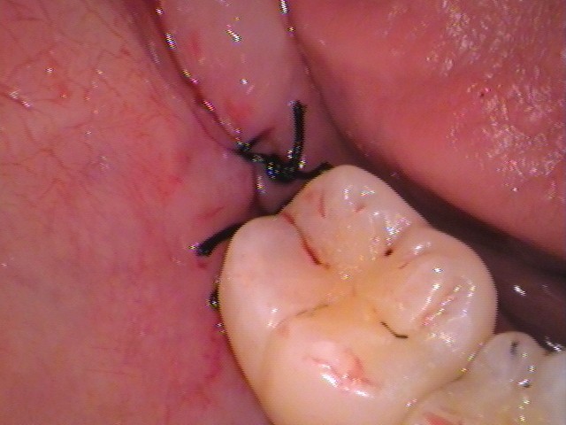 親知らず虫歯　セラミック治療　自由が丘　歯医者