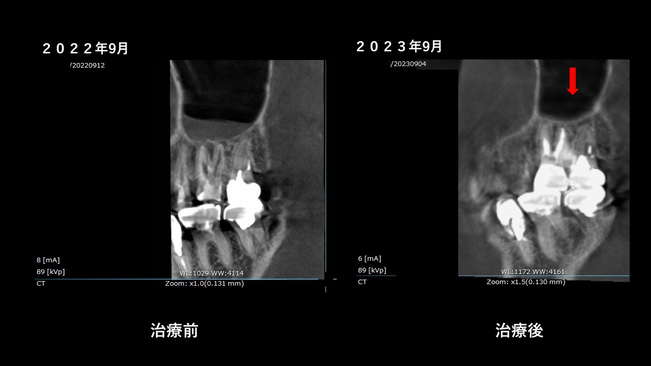 根管治療　マイクロエンド　自由が丘　歯医者　