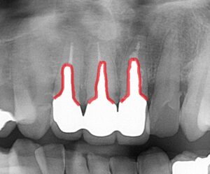 太いメタルコア 歯根破折