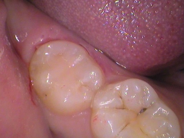 ダイレクトボンディング　レジン　自由が丘　歯医者