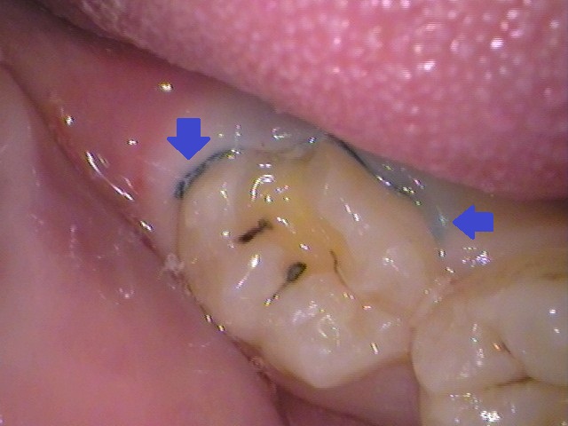 ダイレクトボンディング　レジン　自由が丘　歯医者