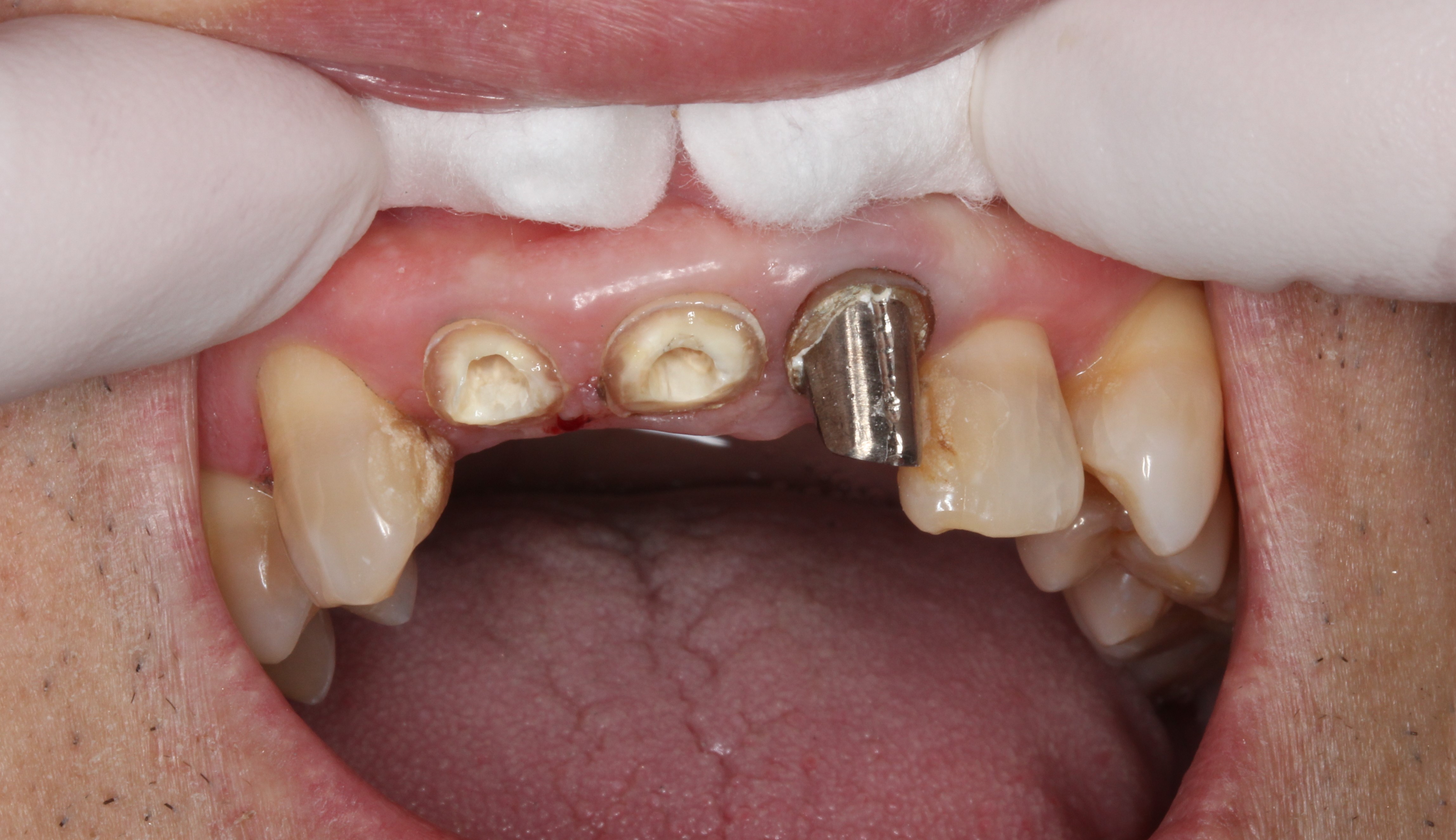 太いメタルコア 歯根破折