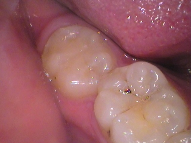 ダイレクトボンディング　レジン　自由が丘　歯医者