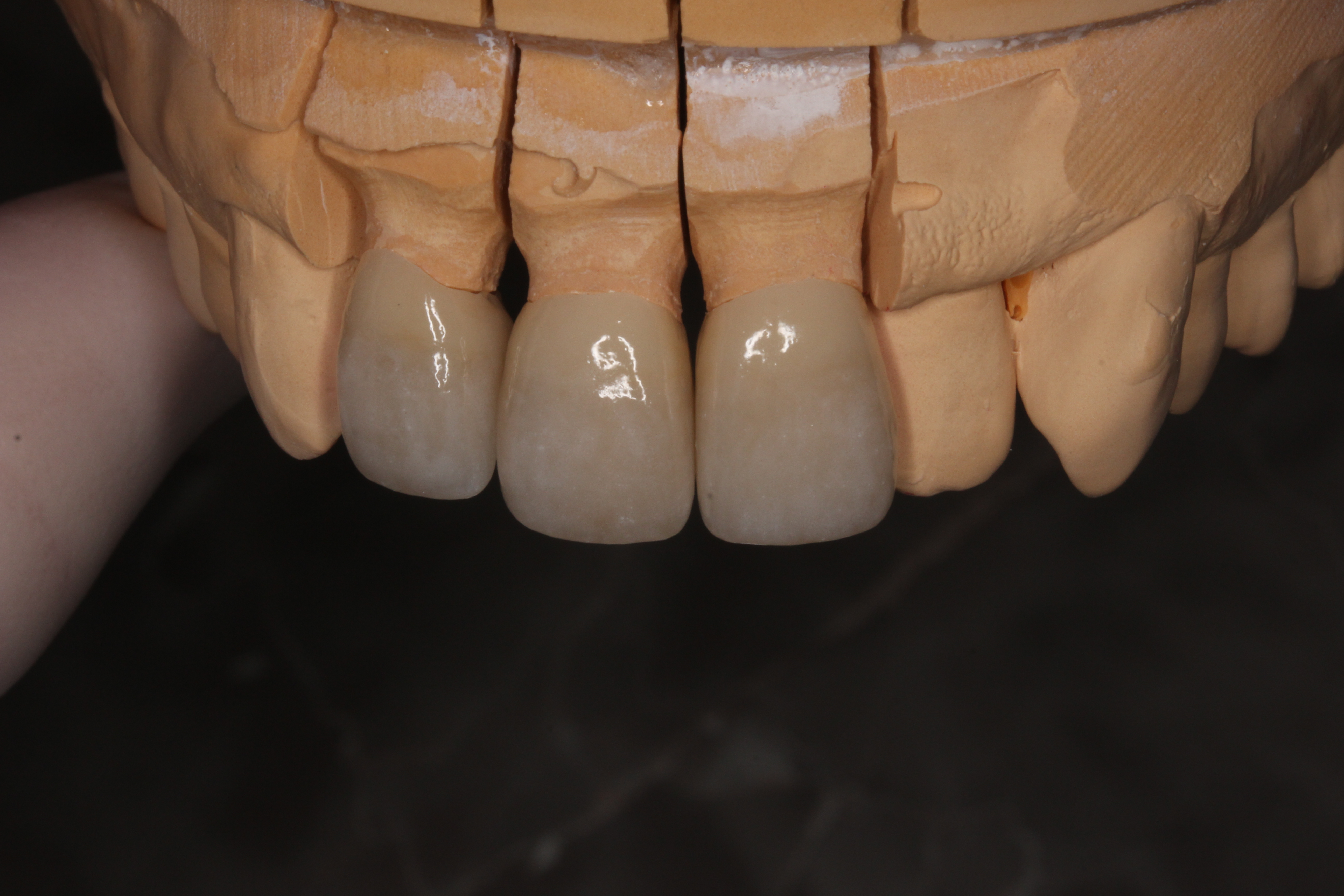 審美歯科 自由が丘 歯医者 セラミック