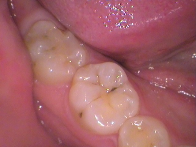 ダイレクトボンディング　レジン　自由が丘　歯医者