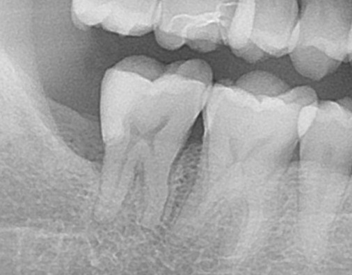 親知らず虫歯　セラミック治療　自由が丘　歯医者
