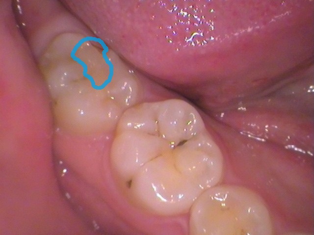 ダイレクトボンディング　レジン　自由が丘　歯医者