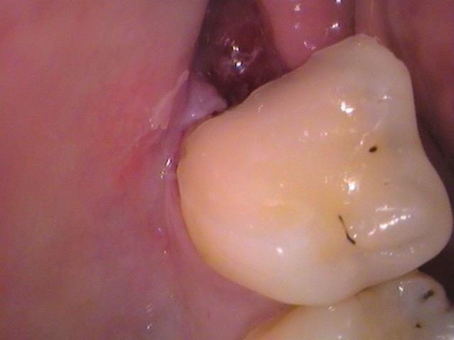 親知らず虫歯　セラミック治療　自由が丘　歯医者