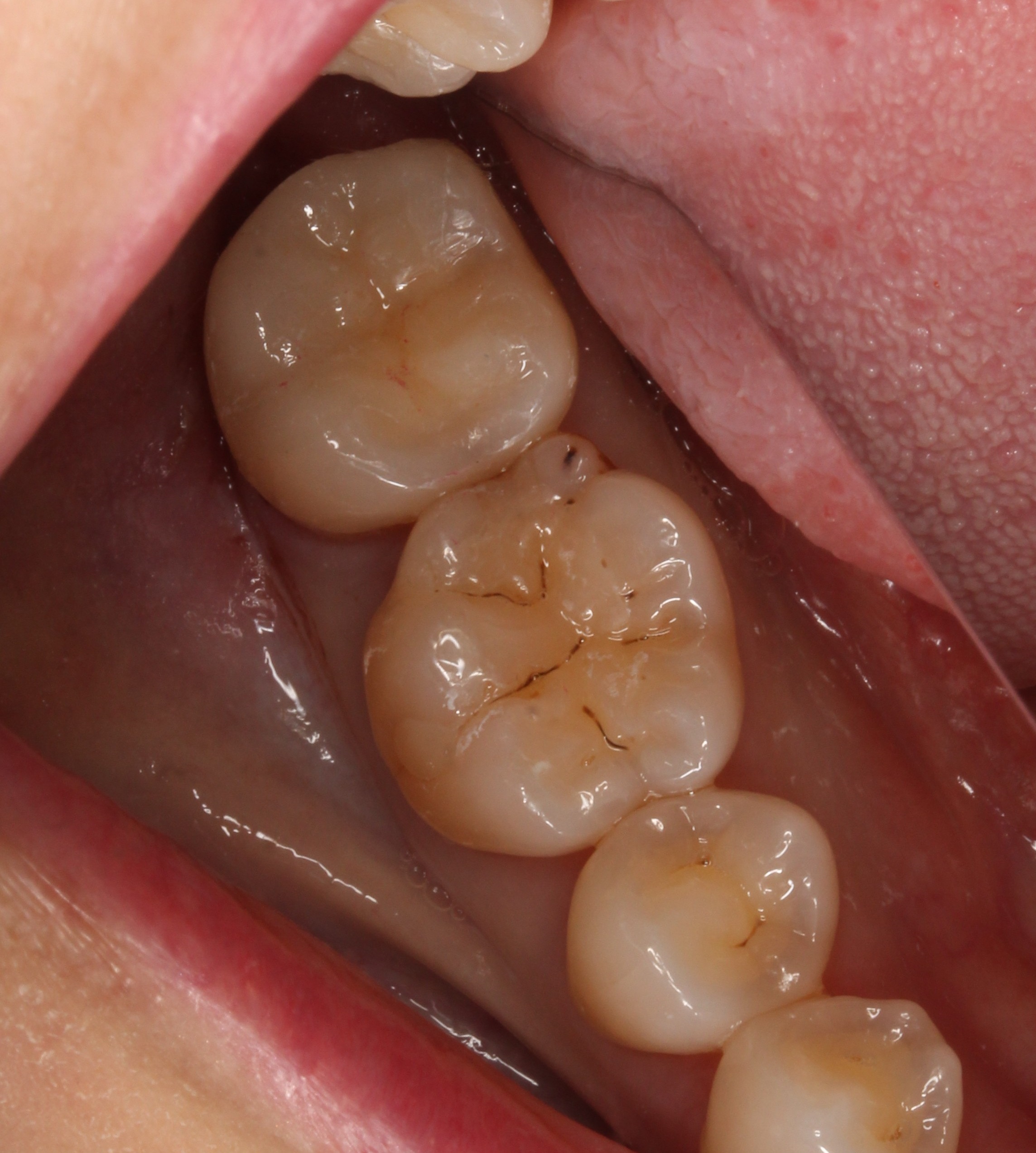 親知らず虫歯　セラミック治療　自由が丘　歯医者