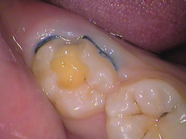 ダイレクトボンディング　レジン　自由が丘　歯医者