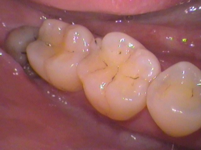 親知らず虫歯　セラミック治療　自由が丘　歯医者