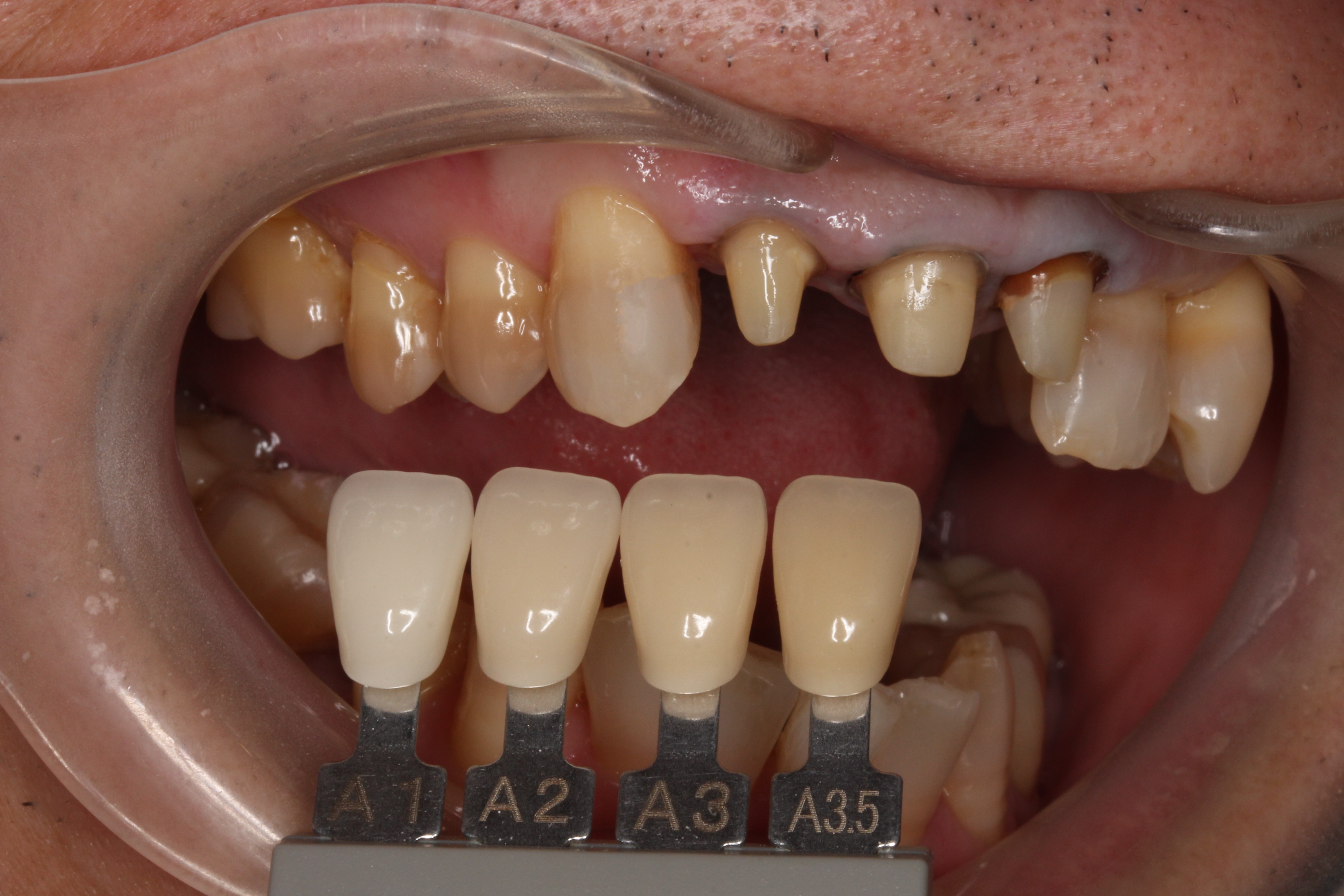 審美歯科 自由が丘 歯医者 セラミック