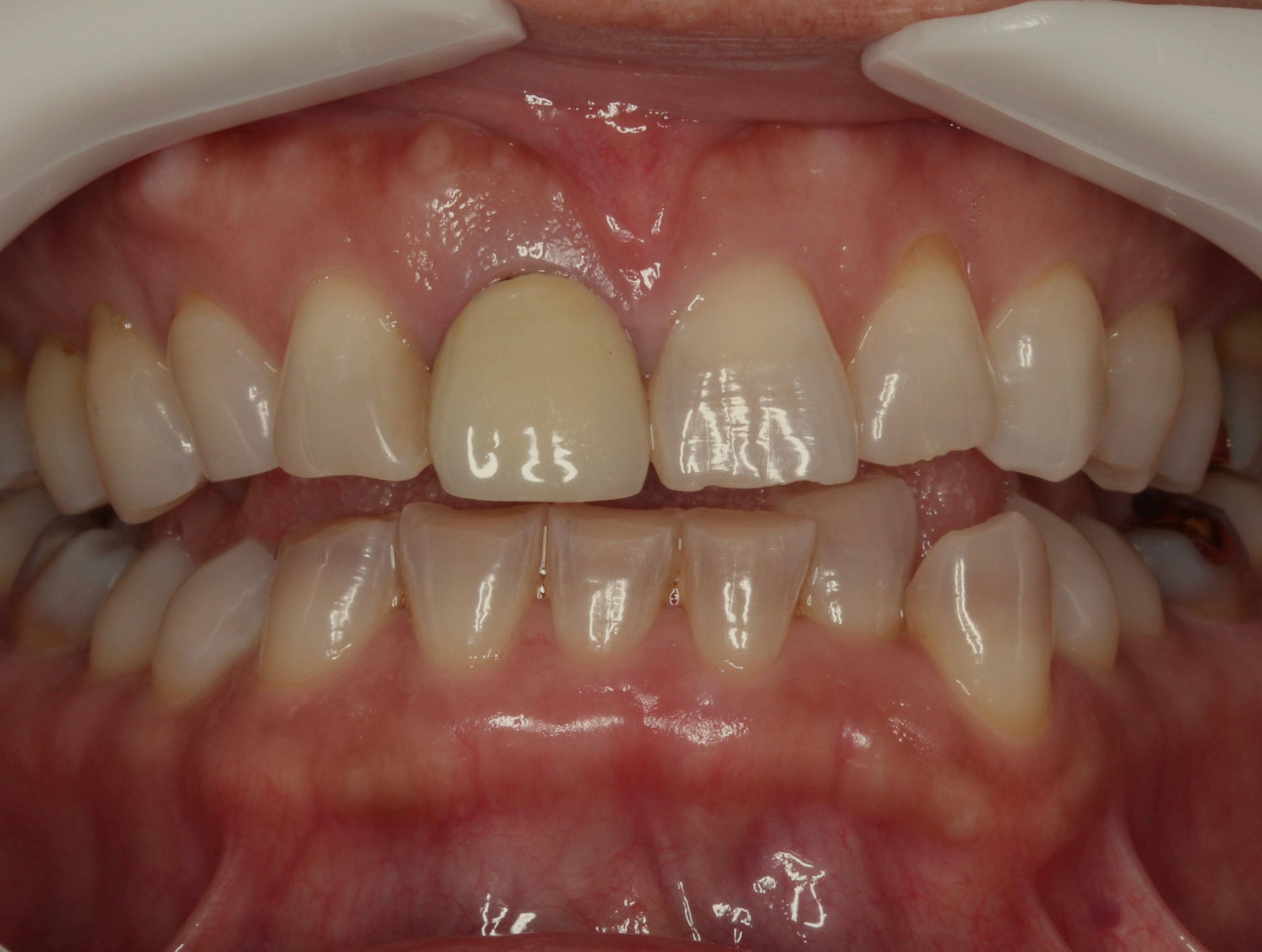 審美歯科 セラミック治療 前歯 自由が丘 歯医者