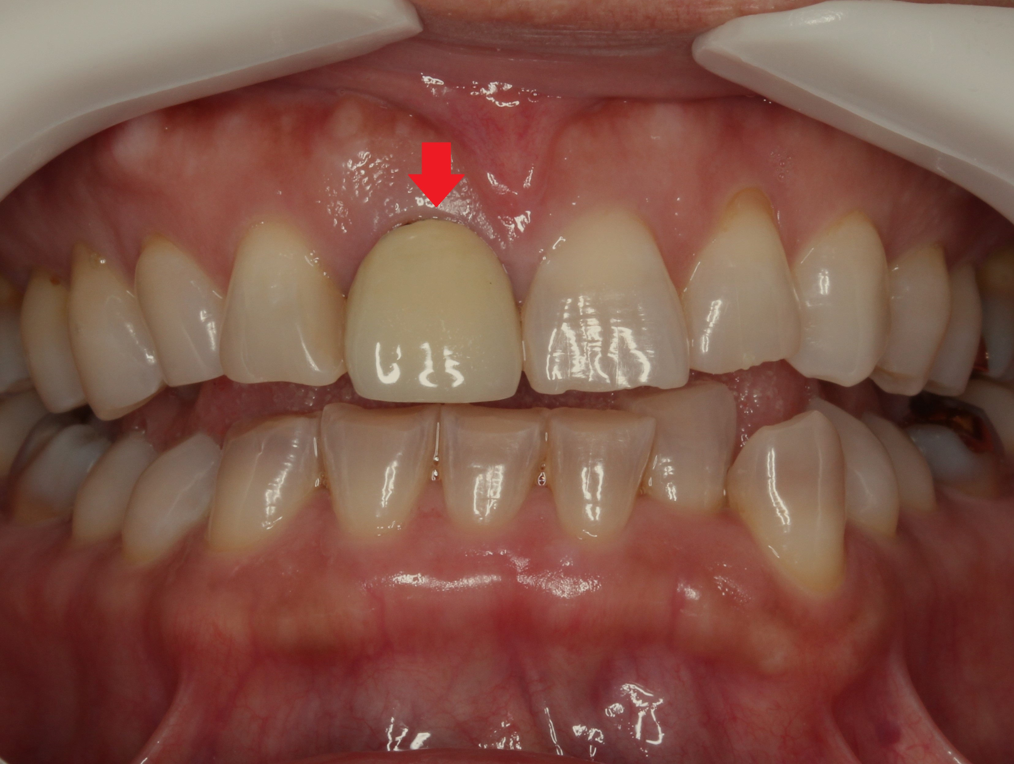 審美歯科 セラミック治療 前歯 自由が丘 歯医者