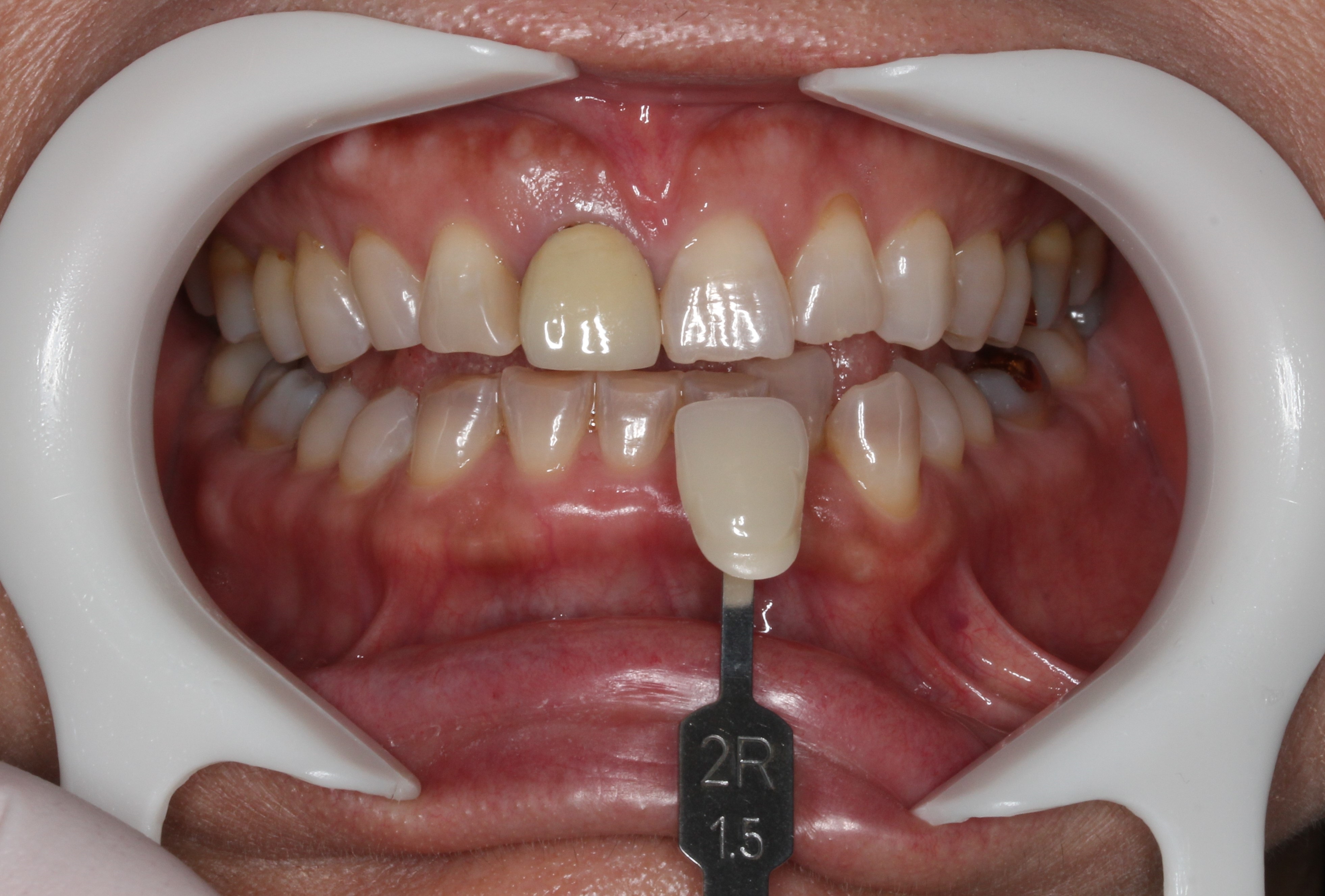 審美歯科　セラミック治療　前歯　自由が丘　歯医者