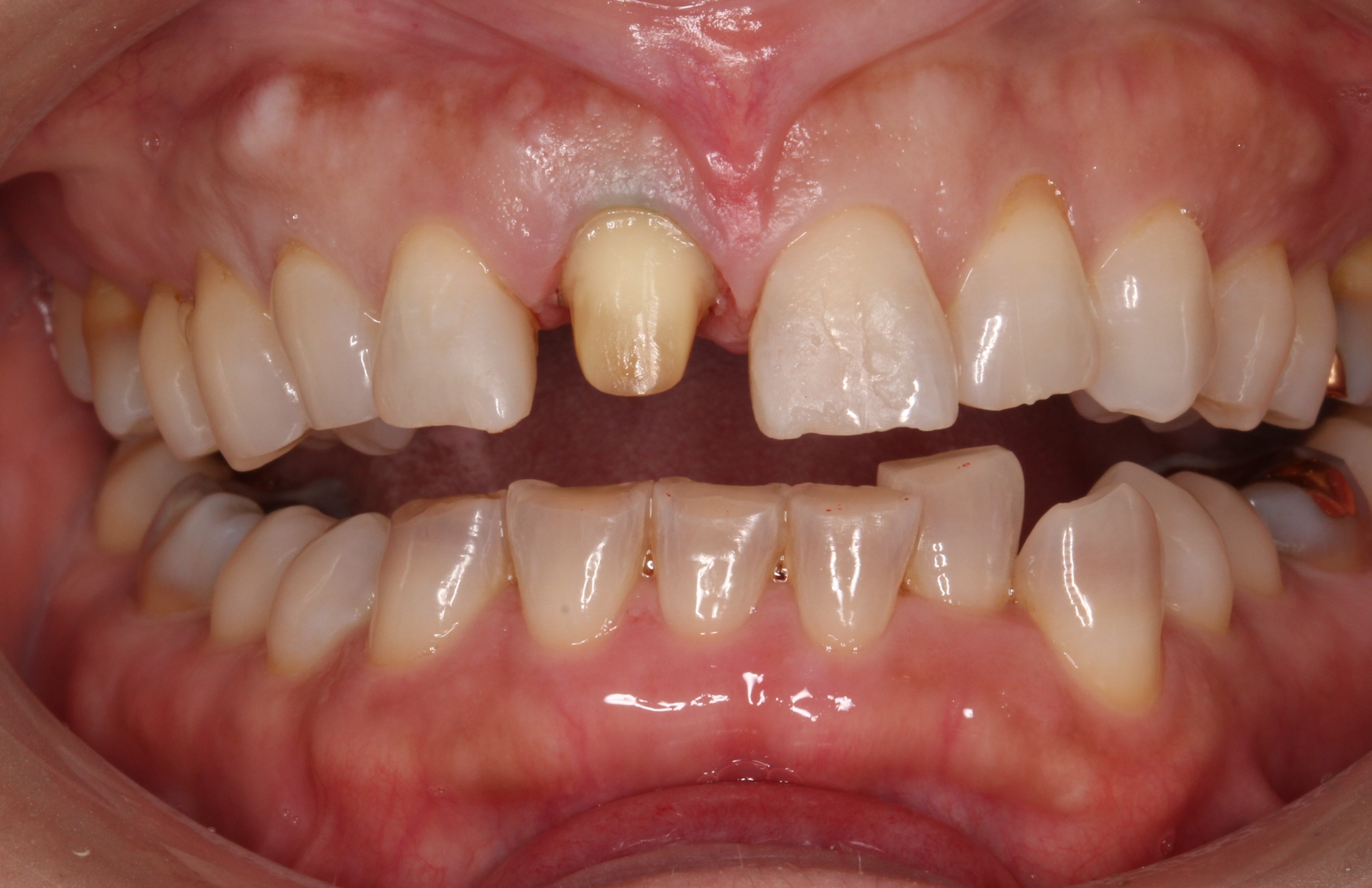 審美歯科 セラミック治療 前歯 自由が丘 歯医者