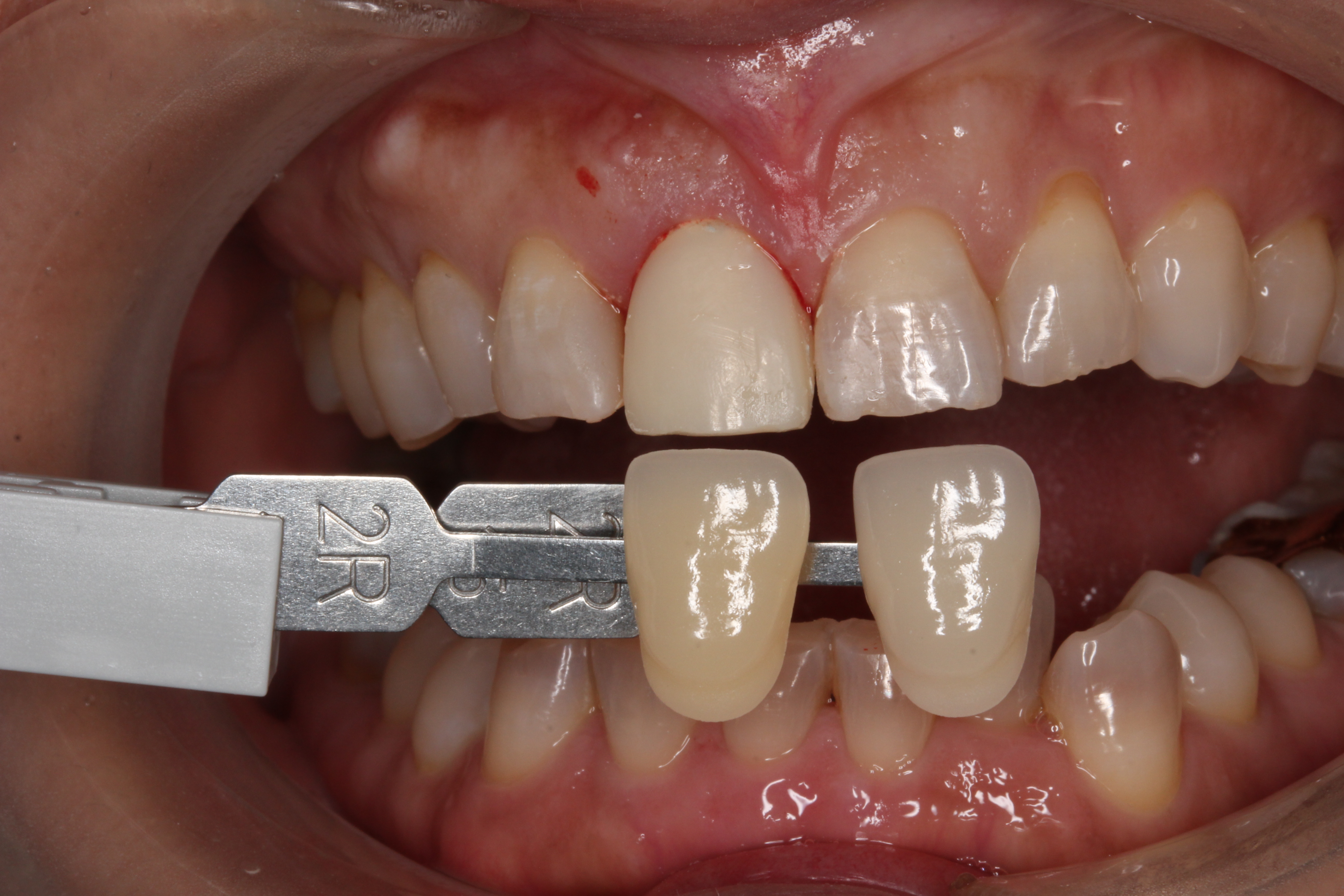 審美歯科 セラミック治療 前歯 自由が丘 歯医者