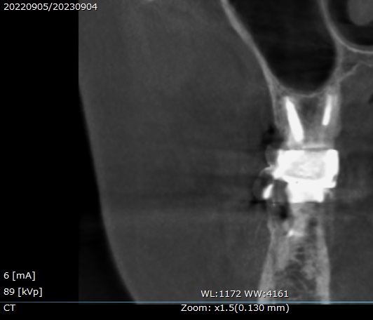 根管治療　マイクロエンド　自由が丘　歯医者　