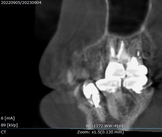 根管治療　マイクロエンド　自由が丘　歯医者　