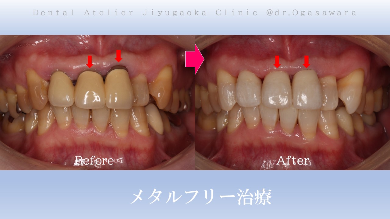 審美歯科 自由が丘 歯医者 セラミック