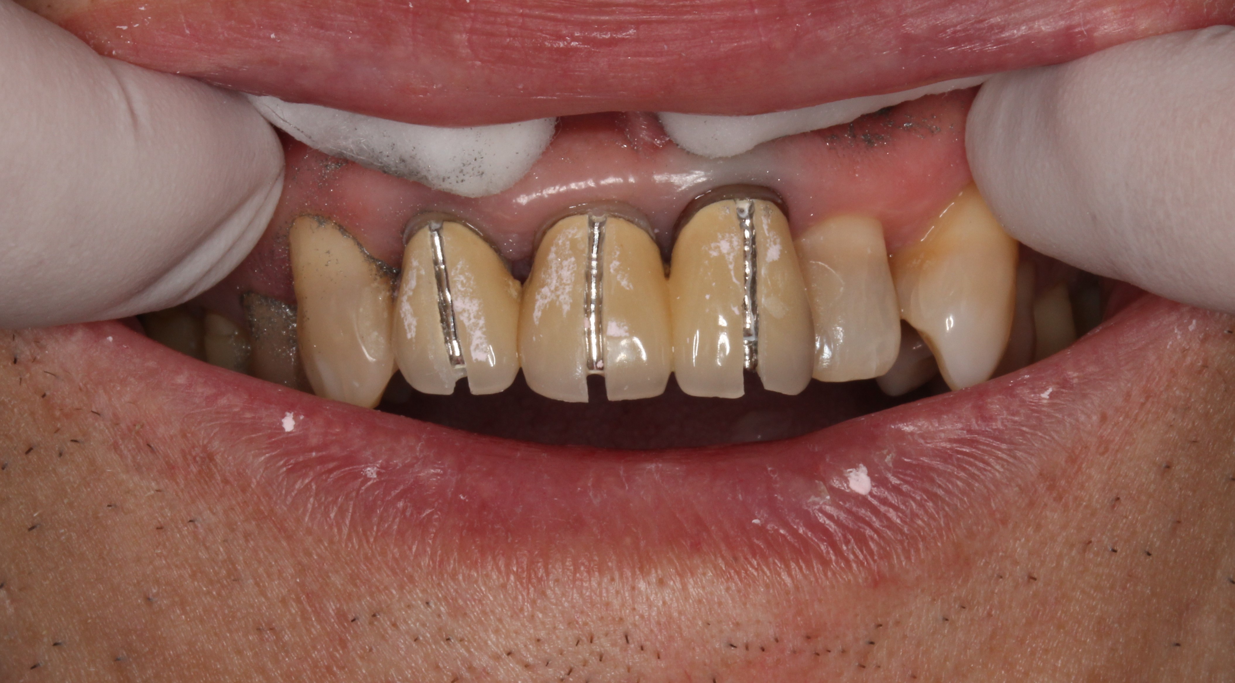 太いメタルコア 歯根破折