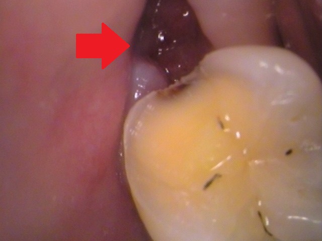 親知らず虫歯　セラミック治療　自由が丘　歯医者