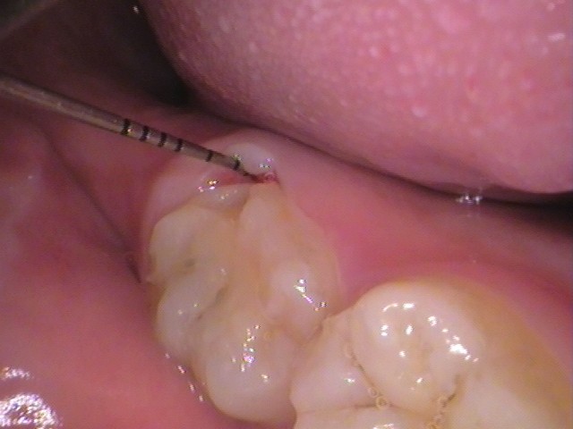 ダイレクトボンディング　レジン　自由が丘　歯医者