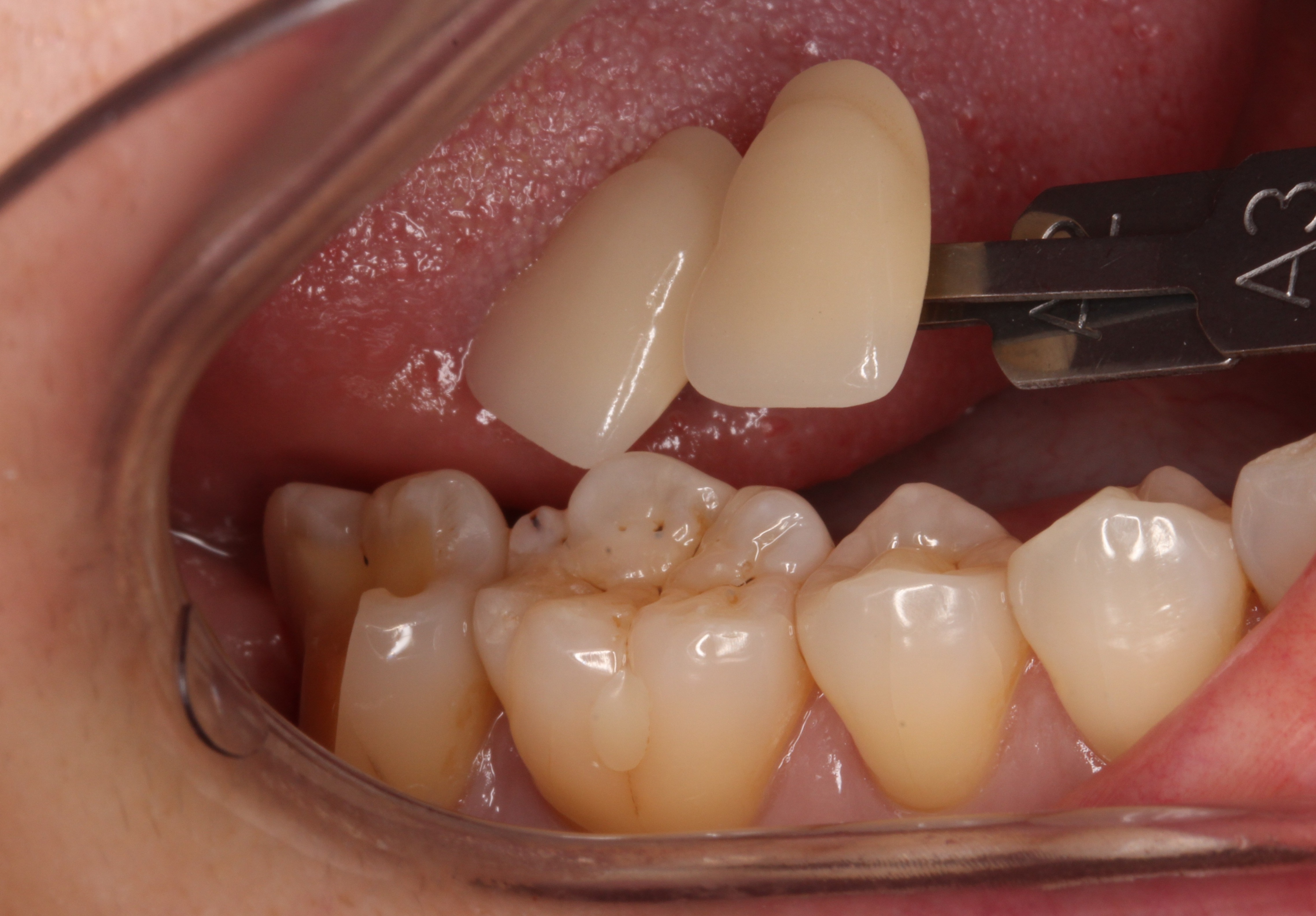 親知らず虫歯　セラミック治療　自由が丘　歯医者