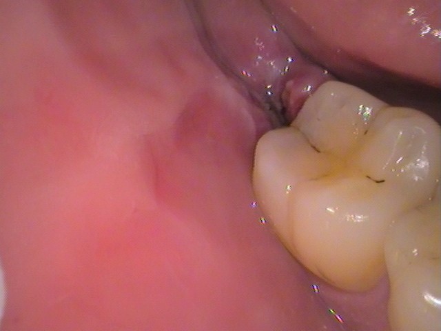 親知らず虫歯　セラミック治療　自由が丘　歯医者