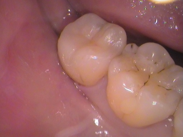 親知らず虫歯　セラミック治療　自由が丘　歯医者