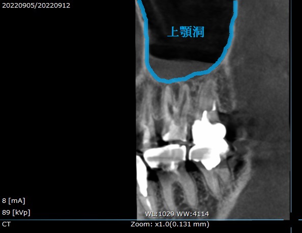根管治療　マイクロエンド　自由が丘　歯医者　