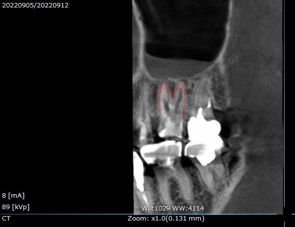 根管治療　マイクロエンド　自由が丘　歯医者　