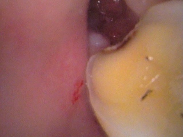 親知らず虫歯　セラミック治療　自由が丘　歯医者