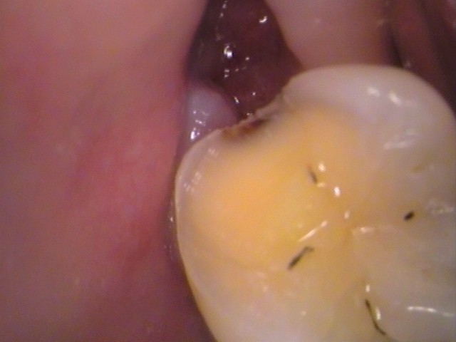 親知らず虫歯　セラミック治療　自由が丘　歯医者