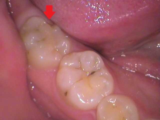 ダイレクトボンディング　レジン　自由が丘　歯医者