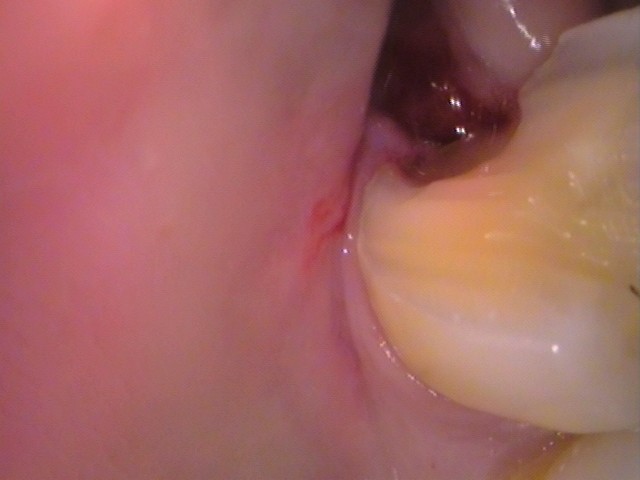 親知らず虫歯　セラミック治療　自由が丘　歯医者