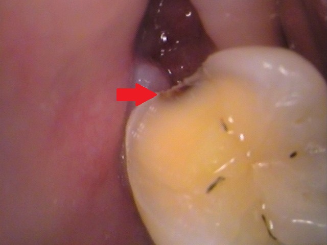 親知らず虫歯　セラミック治療　自由が丘　歯医者