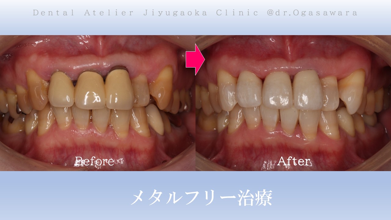 審美歯科 自由が丘 歯医者 セラミック