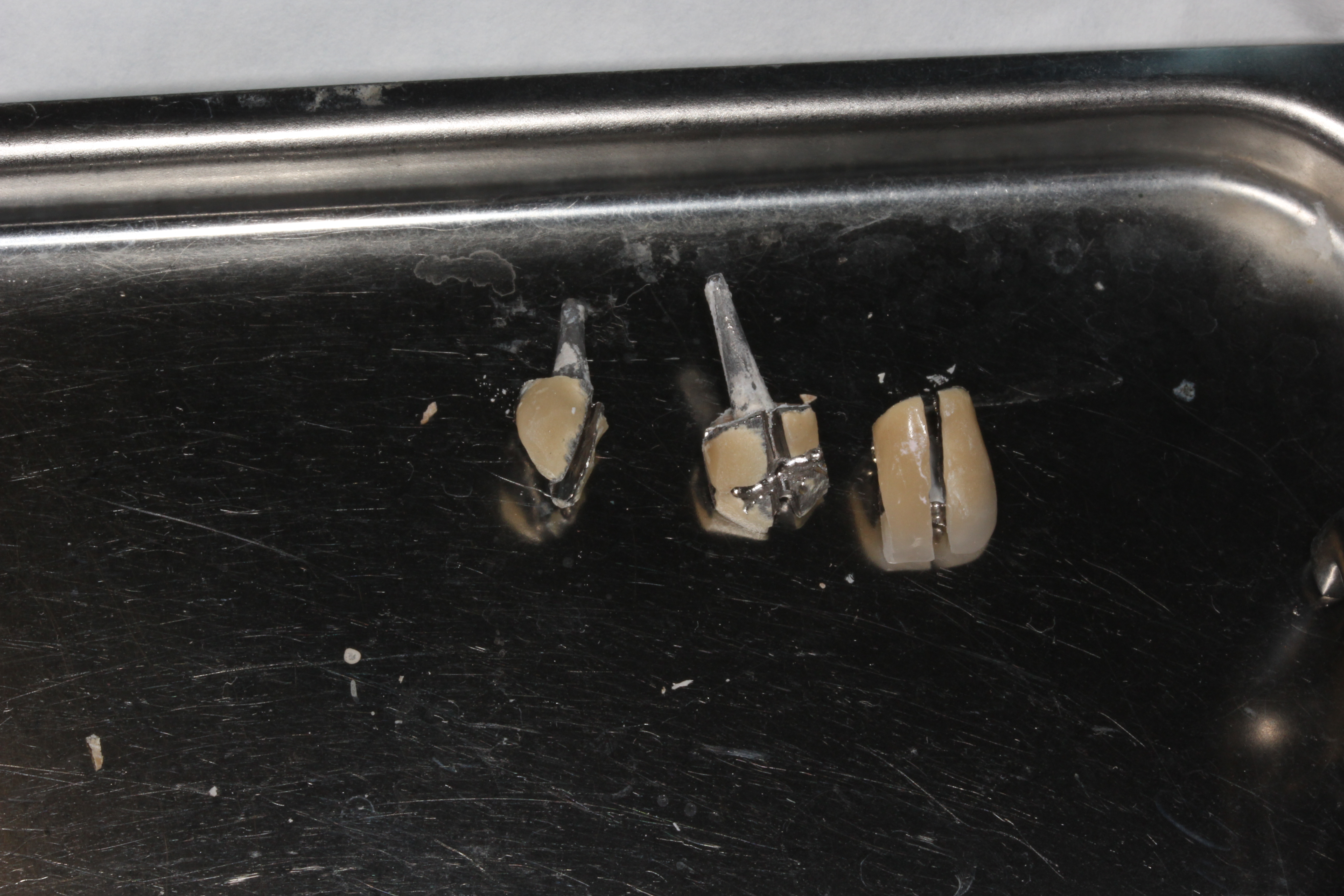 太いメタルコア 歯根破折