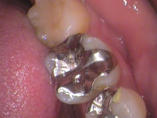 銀歯　虫歯　セラミック　自由が丘　歯医者