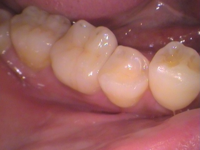 銀歯　セラミックインレー　虫歯　自由が丘　歯医者