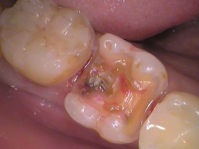 銀歯　セラミックインレー　虫歯　自由が丘　歯医者
